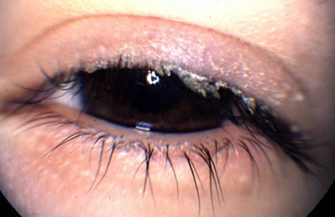 En la blefaritis las pestañas acumulan secreciones y esto evita el buen funcionamiento de la lagrima podiendo provocar baja de visión.