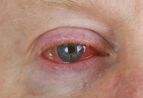 La conjuntivitis es la causa más frecuente de ojo rojo, la inflamación de la conjuntiva puede llevarnos a baja de la visón.