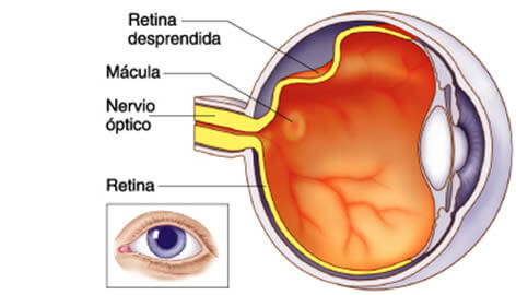 Personas con miopía son más propensas a padecer de desprendimientos de retina.