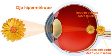 Las personas con hipermetropía no consgiuen una imagen nítida porque su foco está detrás de la retina.
