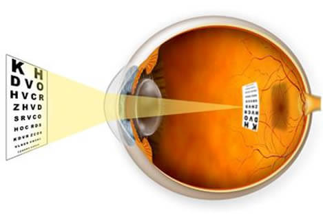 Las personas con miopía no consiguen focar la imagen en la retina, en su lugar la imagen es focada antes de ella y por eso se percibe borrosa.