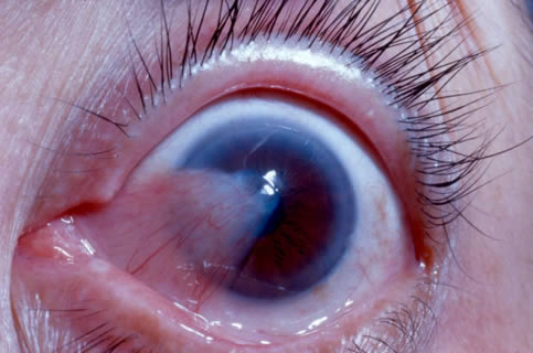 El pterigio en su grado más avanzado pude llegar hasta la pupila y producir una baja de visón reversible con cirugía.