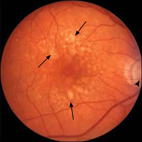 Las drusas (flechas) presentes en la degeneración macular relacionada con la edad alteran la anatomía de la mácula.