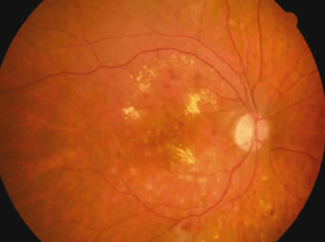 La inflamación del centro de la retina causado por la diabetes puede ocasionar visión con metamorfopsias.