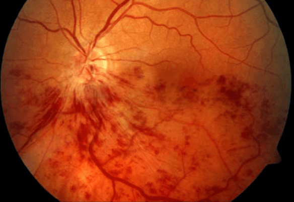 En los infartos de la retina, la mácula también puede presentar inflamación y causar metamorfopsias