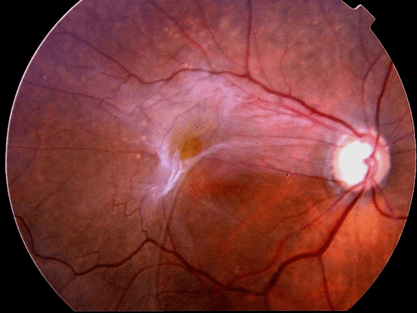Las membranas que están encima de la retina pueden causar una visión distorsionada.
