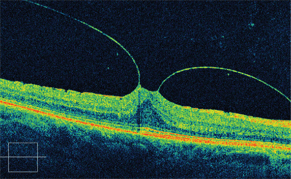 En la imagen observamos una tomografía de coherencia óptica mostrando una tracción vítrea jalando la retina que puede causar una visión con metamorfopsias.