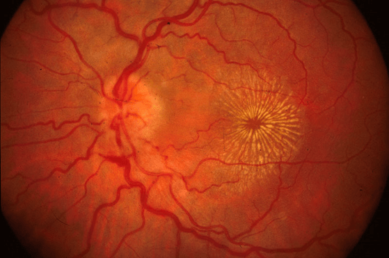 Las infecciones o procesos autoinmunes que afectan el fondo de ojo pueden cursar con metamorfopsias.