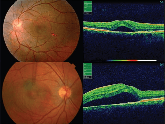 En la imagen observamos un ojo con un desprendimiento seroso de la retina confirmado por tomografía, característico de la Coroidopatia Serosa Central que causa metamorfopsias.