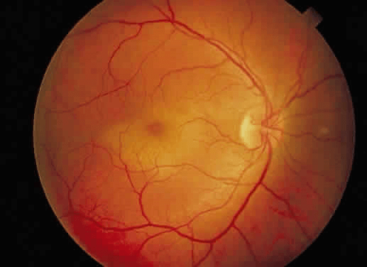 En los traumas contusos severos del globo ocular la mácula puede inflamarse y ocasionar una visión distorsionada.