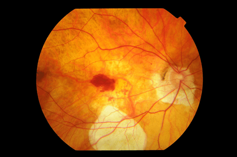 En la imagen observamos una degeneración macular por alta miopía que puede cursar con metamorfopsias.