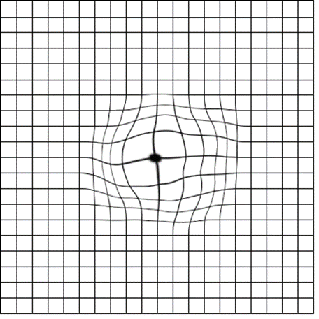 En la imagen observamos una rejilla de Amsler con líneas curvas en su centro.