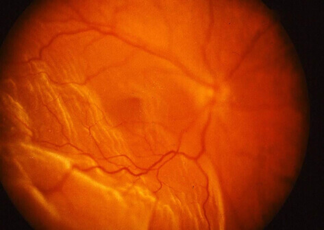En la imagen observamos un desprendimiento de retina en el cual uno de los síntomas iniciales son las miodesopsias.