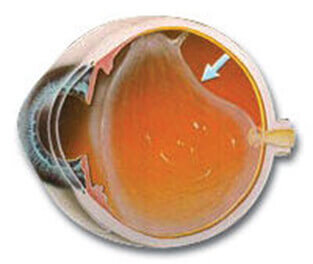 En la imagen observamos como se separa el vítreo de la retina ocasionando las miodesopsias.