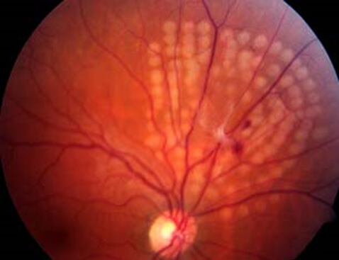 En la imagen observamos una lesión traccional de la retina cercada con laser para tratar miodesopsias.