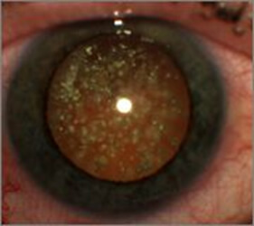 En la imagen observamos cristales de colesterol dentro del ojo en el humor vítreo, que pueden causar miodesopsias.