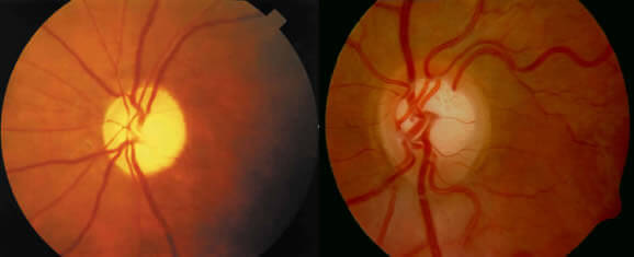 En la imagen observamos a la izquierda un disco óptico normal y a la derecha uno con daños permanentes por Glaucoma.