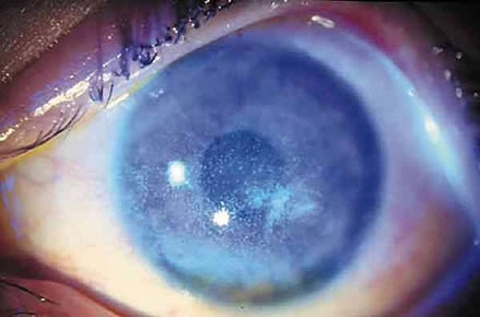 El daño a la córnea por estímulo luminoso en exceso puede causar dolor intenso y baja de visión temporal.