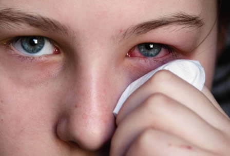 La conjuntivitis viral generalmente afecta un ojo primero y luego se vuelve bilateral, es altamente contagiosa.