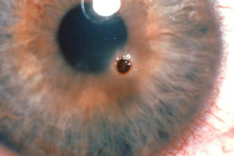 Pacientes con algunas enfermedades específicas del ojo, entre ellas el cuerpo extraño en la córnea pueden padecer de fotofobia.