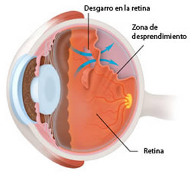 Cuando existe un desgarro de la retina, si no es tratado puede llevar a un desprendimiento de retina.