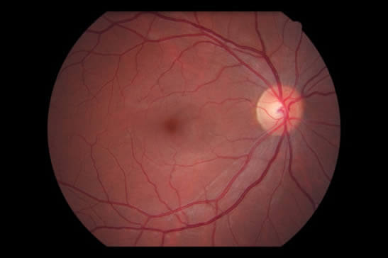 La retina o fondo de ojo normal sin ningún tipo de enfermedad.