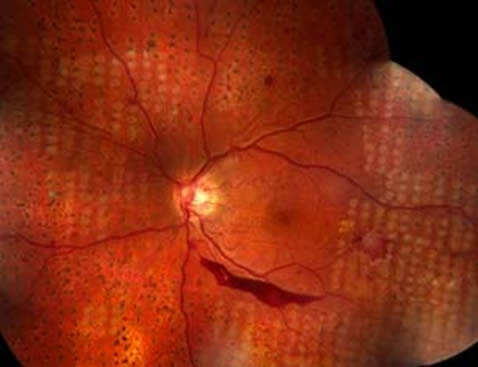 El tratamiento ideal para la retinopatía diabética es la fotocoagulación laser de la retina