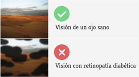El paciente con retinopatía diabética puede tener este tipo de visión en etapas avanzadas de la enfermedad.