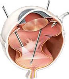 La vitrectomia es la técnica más moderna para tratar desprendimientos de retina.