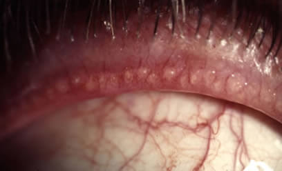 En la Blefaritis Posterior observamos una obstrucción de las glándulas de los parpados llamadas glándulas de Meibomio.