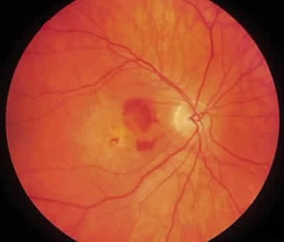 En la DMRE húmeda podemos observar hemorragias del fondo de ojo.