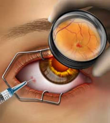 El tratamiento de avanzada para la DMRE es la aplicación de medicamentos dentro del ojo.