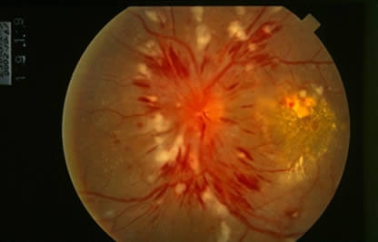 En Retinopatia Hipertensiva Grave podemos tener inflamación de la macula y del nervio óptico llevando a ceguera irreversible si no es tratada a tiempo.