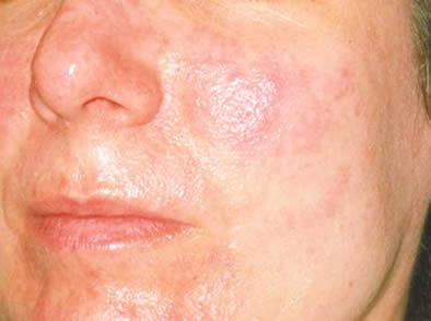 Personas con Acné rosácea son más propensas a padecer de blefaritis.