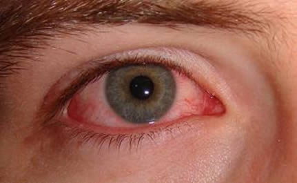 Al tener ojo rojo, es mejor evitar el uso del Lente de Contacto y visitar su oftalmólogo.