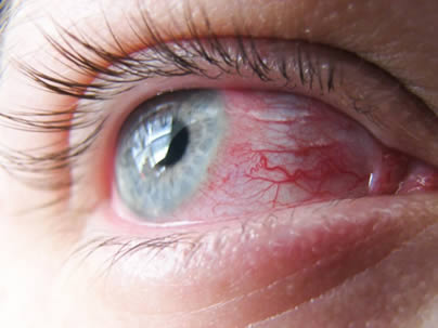 El ojo rojo así como la comezón en el ojo son los síntomas más frecuentes de alergia ocular.