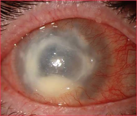 El uso inadecuado de lentes de contacto puede causar problemas serios de visión y hasta ceguera, un ejemplo es la queratitis bacteriana.