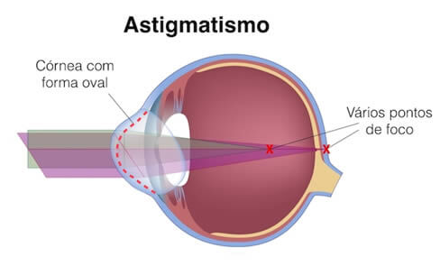 En el astigmatismo tenemos varios puntos de foco en la retina por lo que no se ve bien ni de lejos ni de cerca.