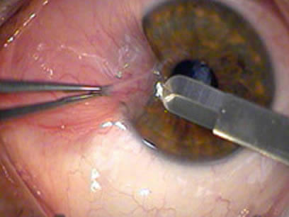 La cirugía de pterigión es realizada por un oftalmólogo calificado.