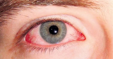 El uso inadecuado de maquillaje puede causar ojo rojo entre otras enfermedades del oculares.