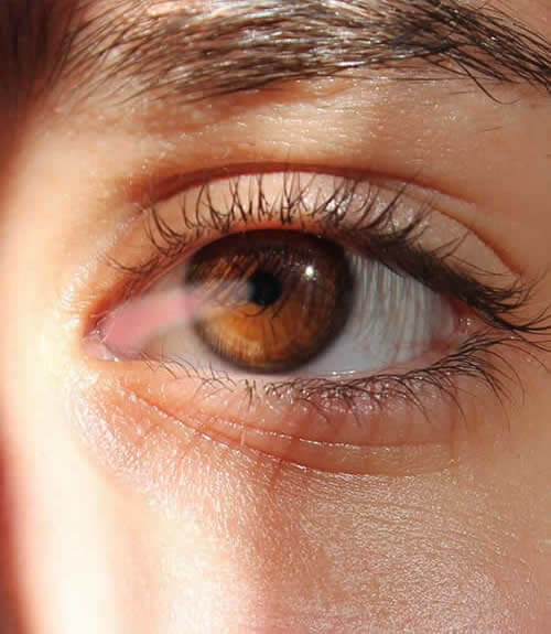 Pterigión-vision borrosa-oftalmologo doctor francisco dacarett honduras hospital santa lucia oftalmologia retina clinica y quirurgica