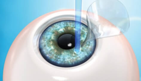 La cirugía LASIK moldea la cornea para darle el grado adecuado a la miopía del paciente.
