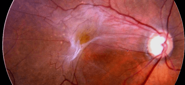 Las membranas que están encima de la retina pueden causar una visión distorsionada.