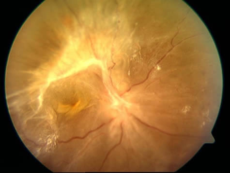 La retinopatía diabética puede cursar con desprendimiento de retina por tracción.