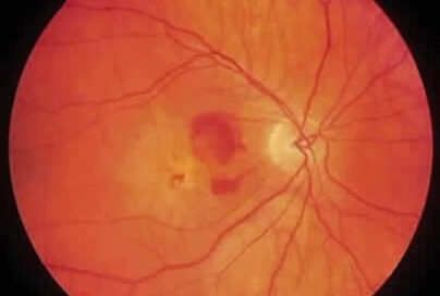 En la DMRE húmeda podemos observar hemorragias del fondo de ojo.