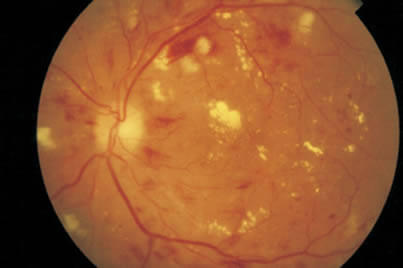 El fondo de ojo en la retinopatía hipertensiva tiene varias hemorragias y exudados blandos ocasionando baja de visión.
