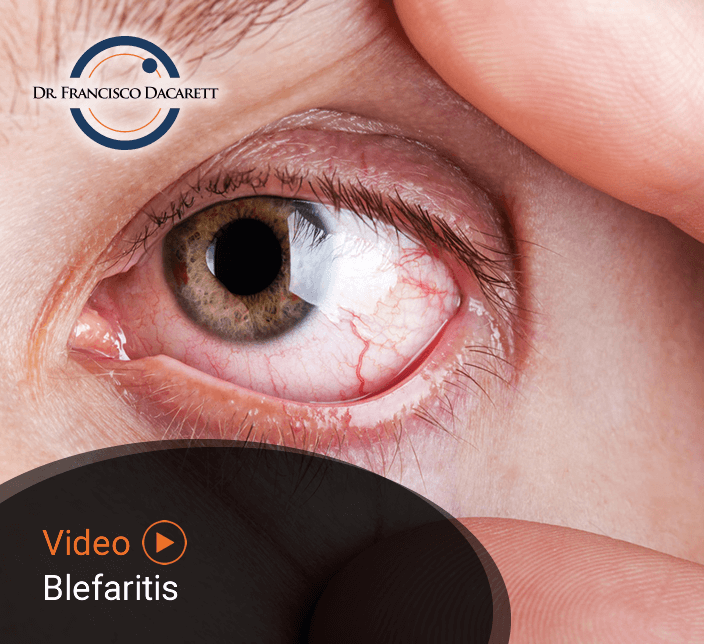 Conoce más sobre la Blefaritis por el oftalmólogo y retinólogo Dr. Francisco Dacarett