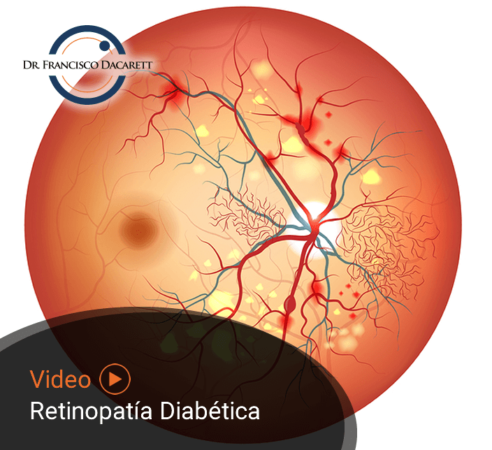 Conoce más sobre la Retinopatía Diabética por el oftalmólogo y retinólogo Dr. Francisco Dacarett
